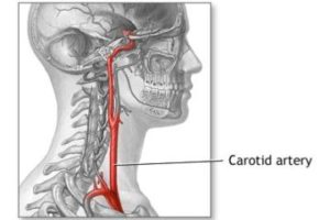 carotid-360x240-300x200 carotid-360x240 