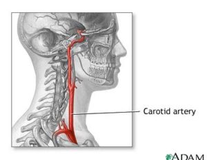 carotid-400x310-300x233 carotid-400x310 