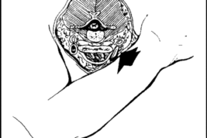 choke3-360x240-300x200 choke3-360x240 